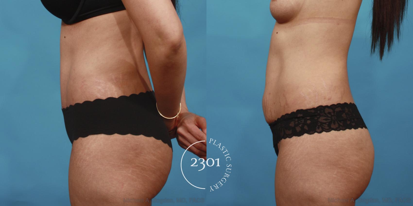 Before & After Tummy Tuck Case 649 Left Side View in Fort Worth, Plano, & Frisco, Texas