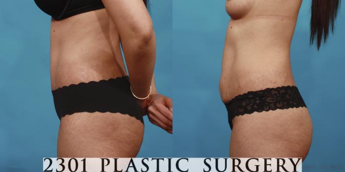 Before & After Tummy Tuck Case 649 Left Side View in Fort Worth, Plano, & Frisco, Texas