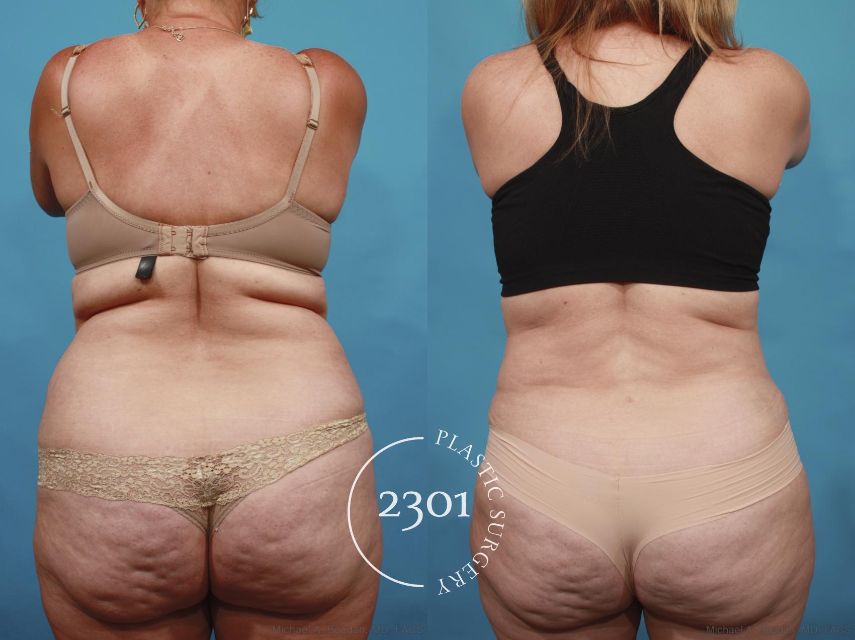 Before & After Tummy Tuck Case 650 Back View in Fort Worth, Plano, & Frisco, Texas