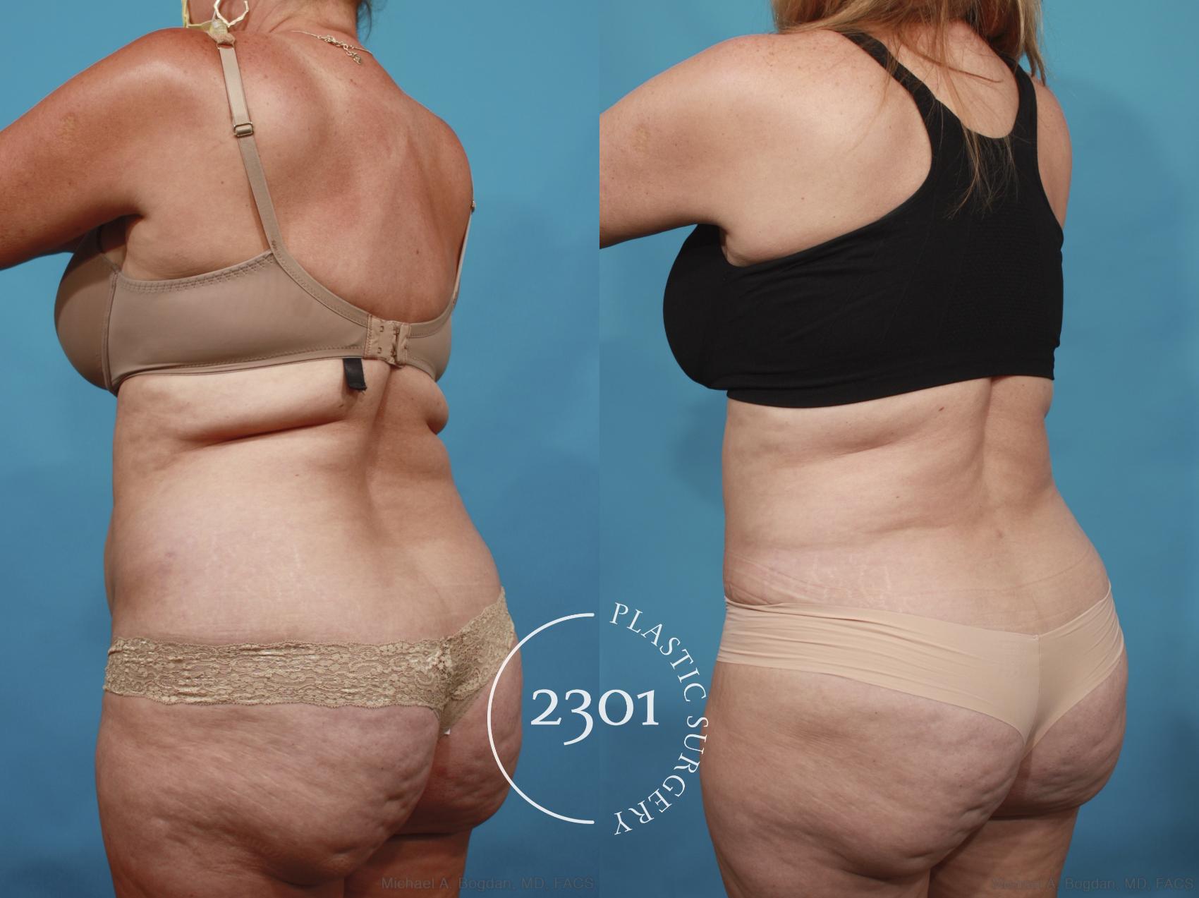 Before & After Tummy Tuck Case 650 Back Left Oblique View in Fort Worth, Plano, & Frisco, Texas