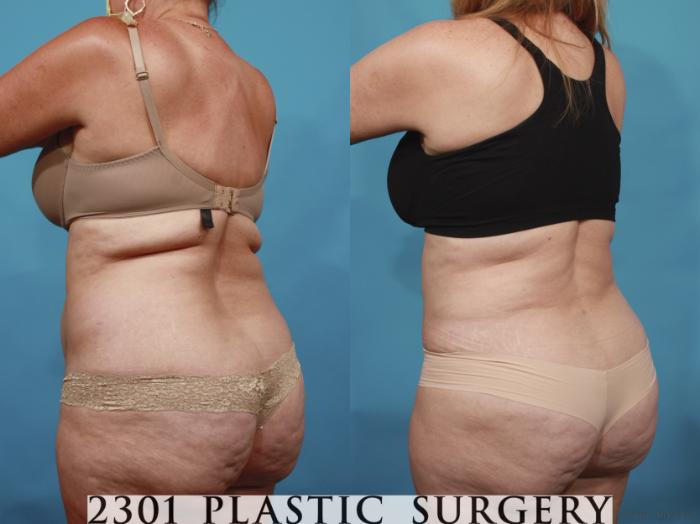 Before & After Tummy Tuck Case 650 Back Left Oblique View in Fort Worth, Plano, & Frisco, Texas