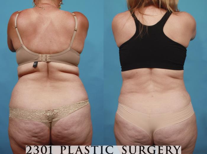 Before & After Tummy Tuck Case 650 Back View in Fort Worth, Plano, & Frisco, Texas