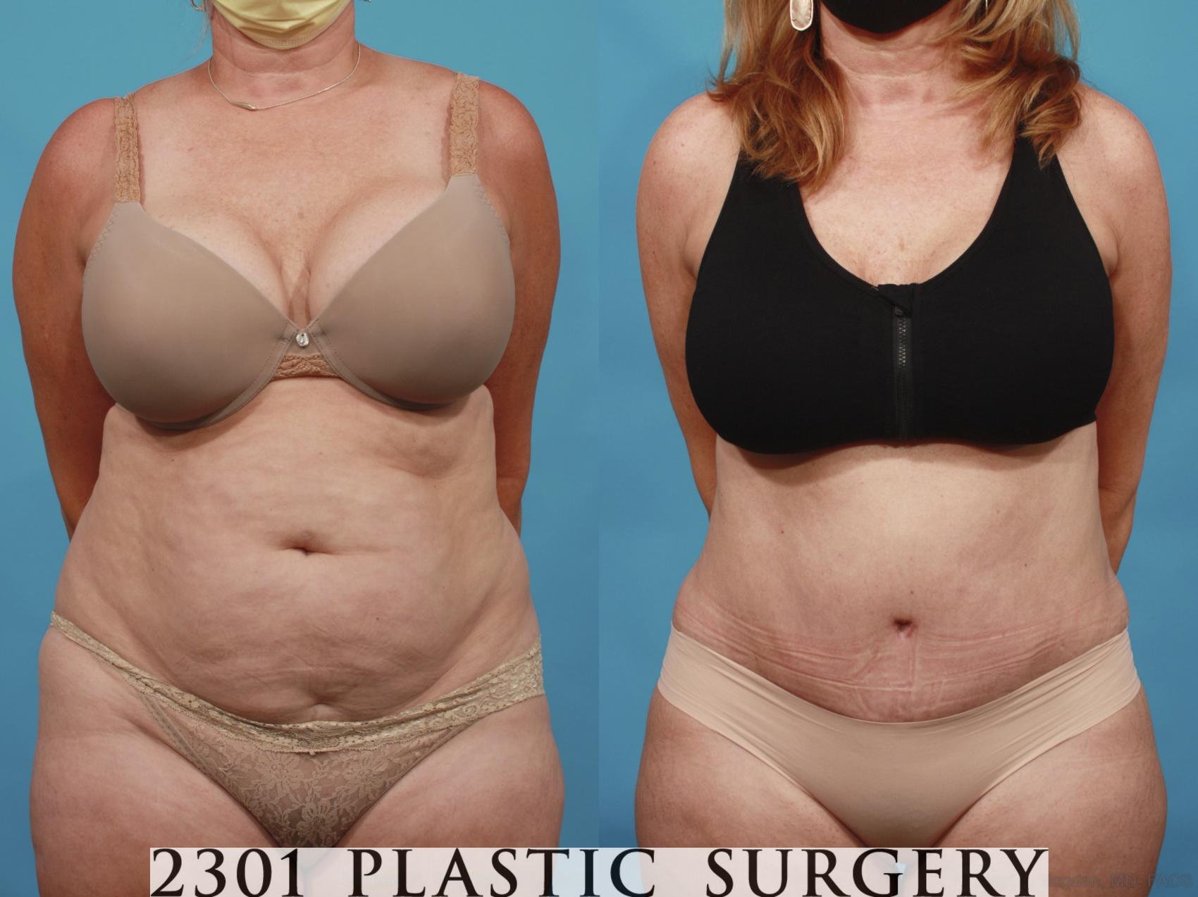 Before & After Tummy Tuck Case 650 Front View in Fort Worth, Plano, & Frisco, Texas