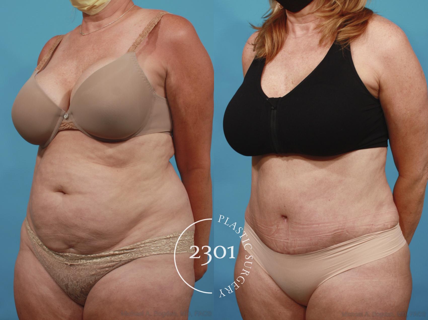 Before & After Tummy Tuck Case 650 Left Oblique View in Fort Worth, Plano, & Frisco, Texas