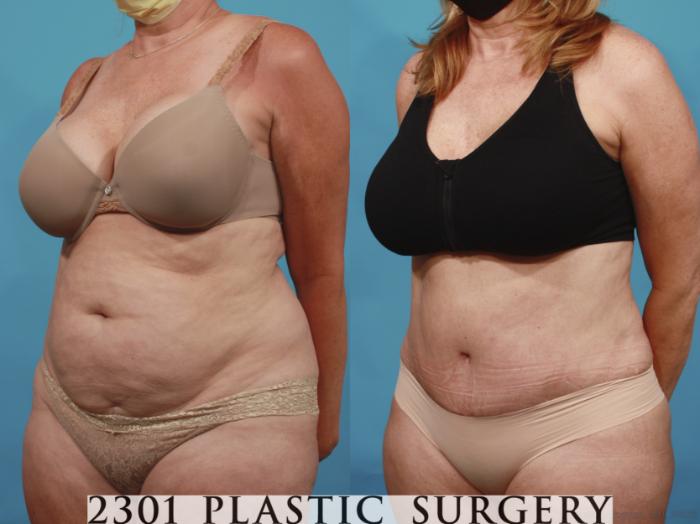 Before & After Tummy Tuck Case 650 Left Oblique View in Fort Worth, Plano, & Frisco, Texas