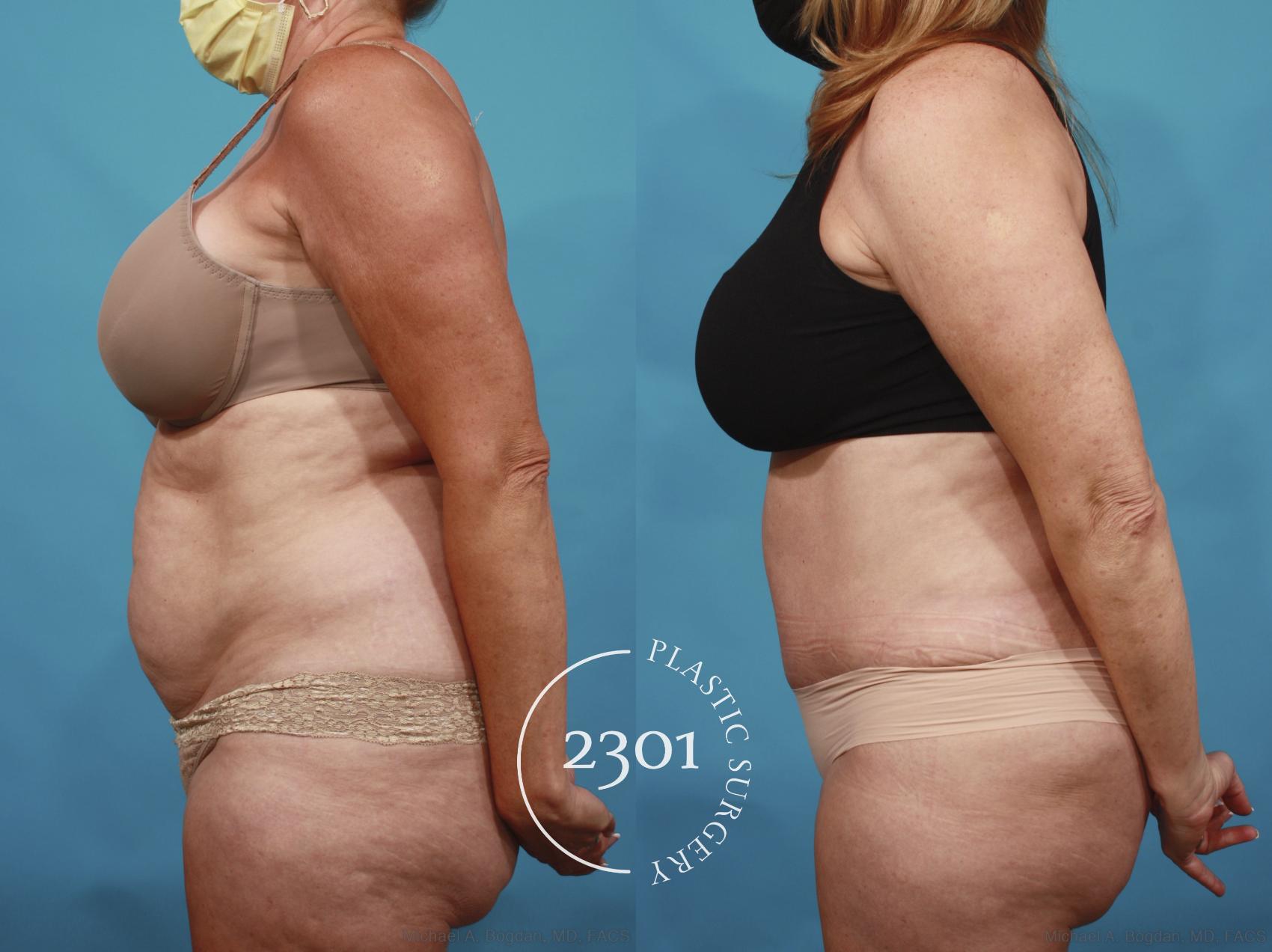 Before & After Tummy Tuck Case 650 Left Side View in Fort Worth, Plano, & Frisco, Texas