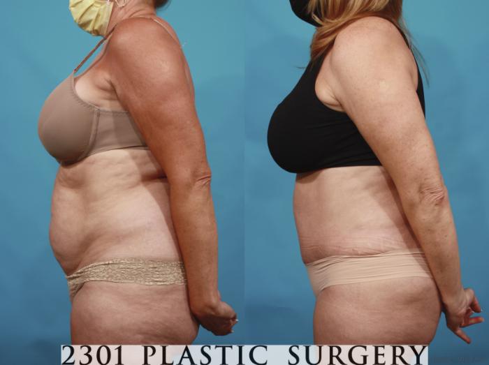 Before & After Tummy Tuck Case 650 Left Side View in Fort Worth, Plano, & Frisco, Texas