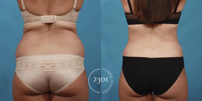 Before & After Tummy Tuck Case 651 Back View in Fort Worth, Plano, & Frisco, Texas