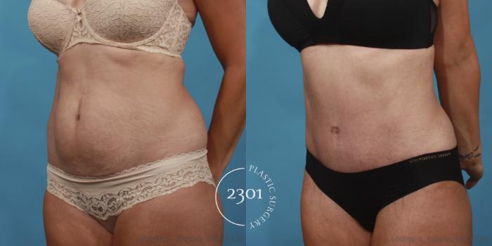 Before & After Tummy Tuck Case 651 Left Oblique View in Fort Worth, Plano, & Frisco, Texas