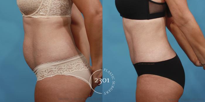 Before & After Tummy Tuck Case 651 Left Side View in Fort Worth, Plano, & Frisco, Texas