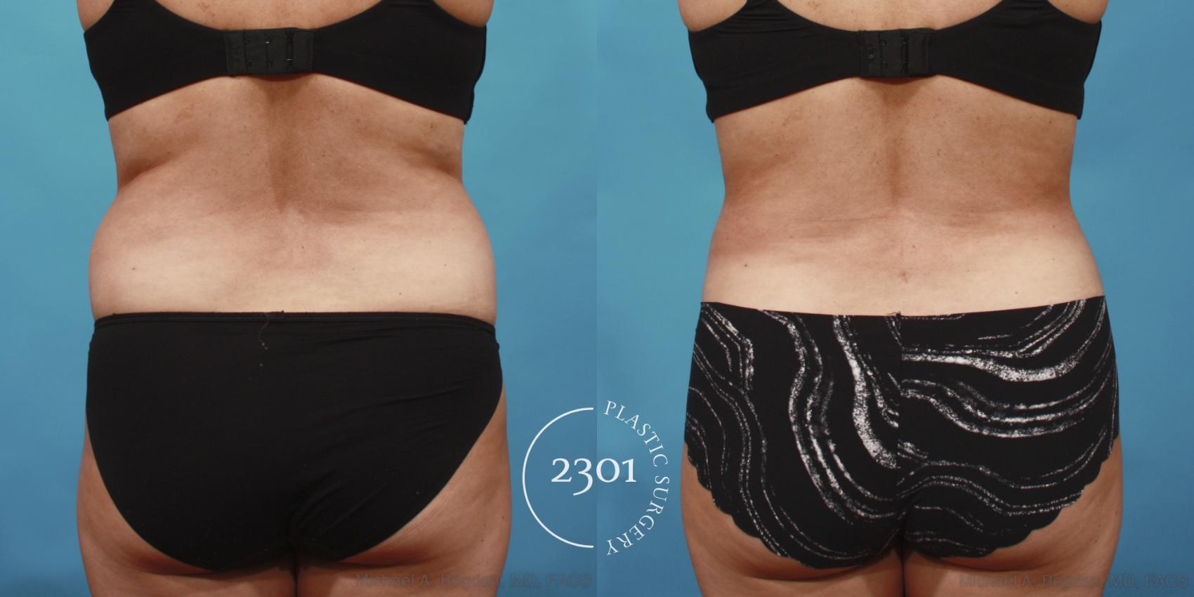 Before & After Tummy Tuck Case 652 Back View in Fort Worth, Plano, & Frisco, Texas