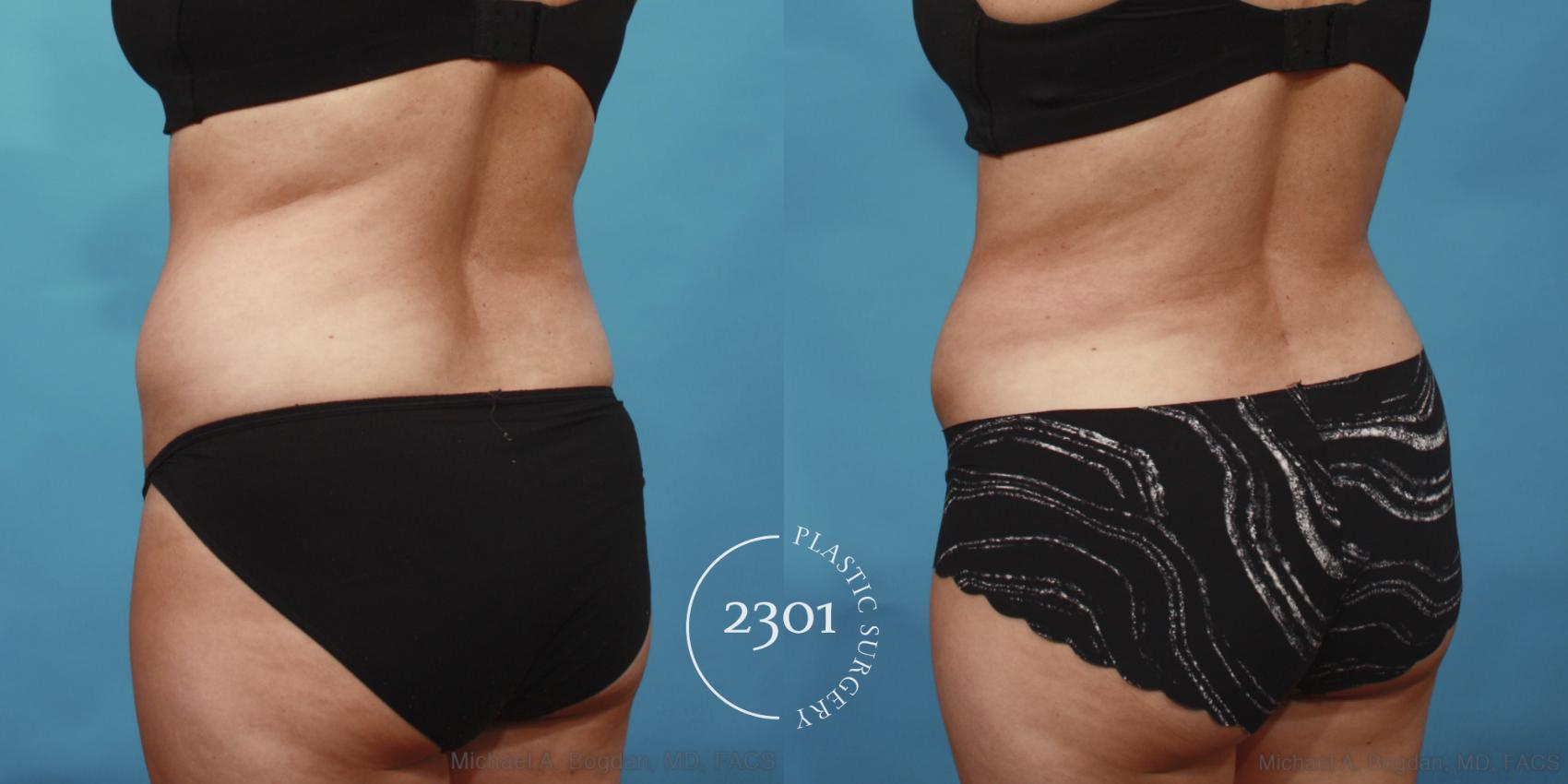 Before & After Tummy Tuck Case 652 Back Left Oblique View in Fort Worth, Plano, & Frisco, Texas