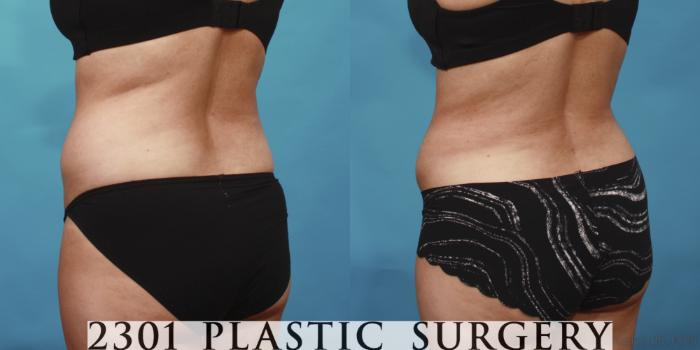 Before & After Tummy Tuck Case 652 Back Left Oblique View in Fort Worth, Plano, & Frisco, Texas
