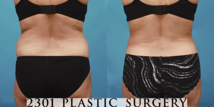 Before & After Tummy Tuck Case 652 Back View in Fort Worth, Plano, & Frisco, Texas