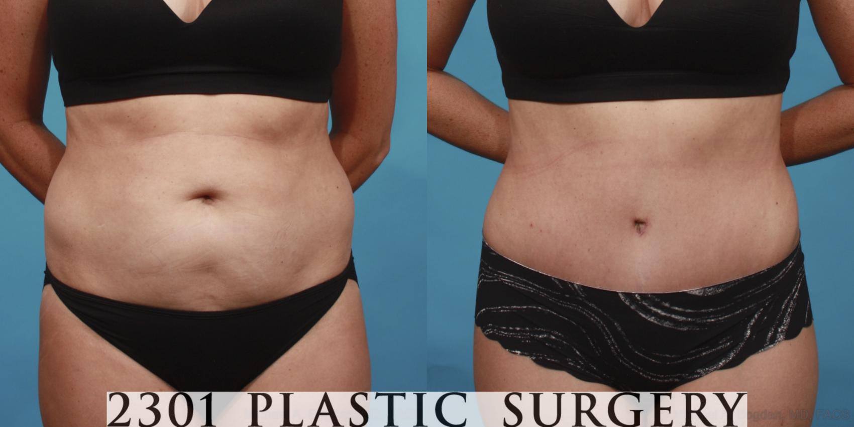 Before & After Tummy Tuck Case 652 Front View in Fort Worth, Plano, & Frisco, Texas