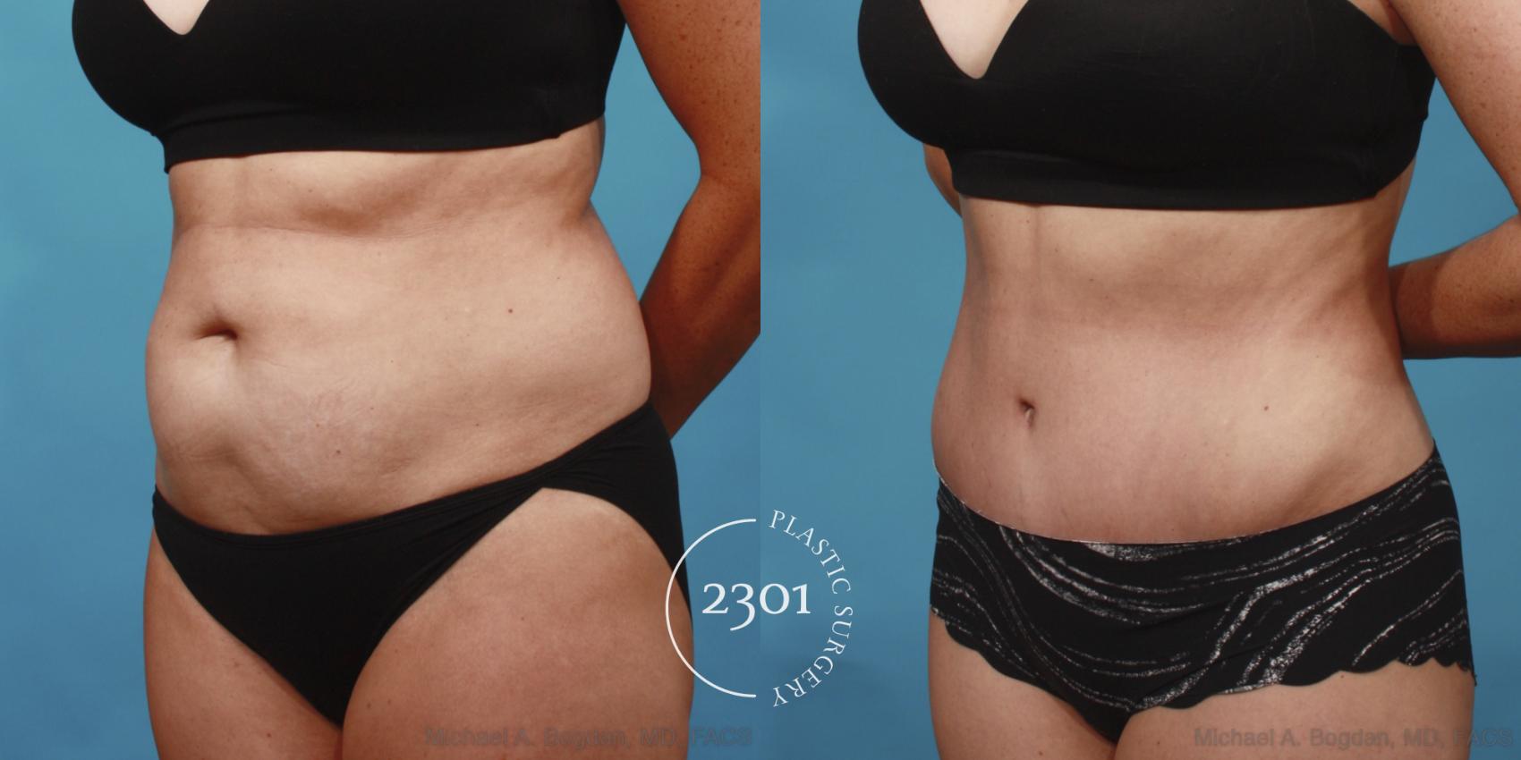 Before & After Tummy Tuck Case 652 Left Oblique View in Fort Worth, Plano, & Frisco, Texas