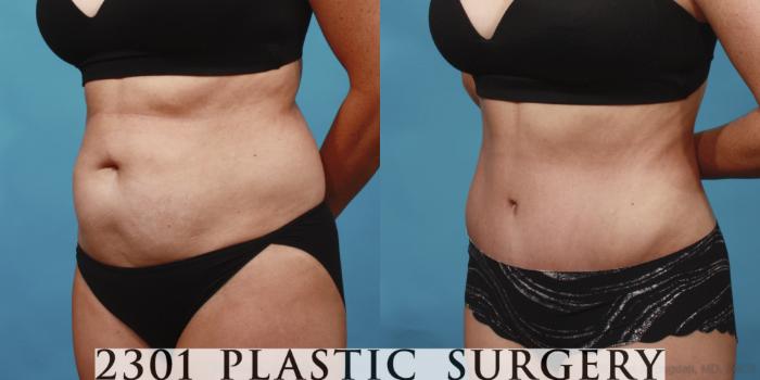 Before & After Tummy Tuck Case 652 Left Oblique View in Fort Worth, Plano, & Frisco, Texas