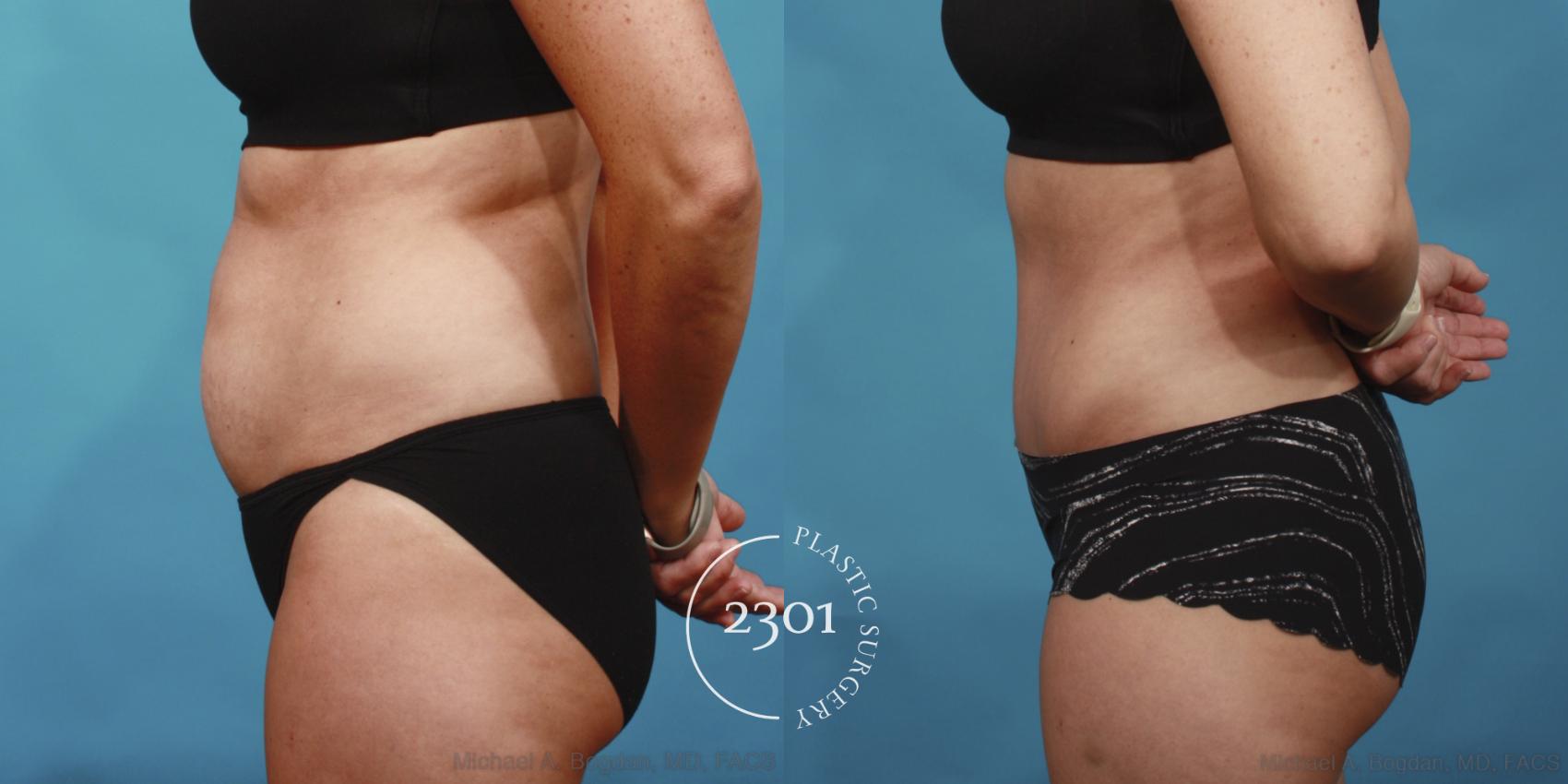 Before & After Tummy Tuck Case 652 Left Side View in Fort Worth, Plano, & Frisco, Texas