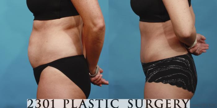 Before & After Tummy Tuck Case 652 Left Side View in Fort Worth, Plano, & Frisco, Texas
