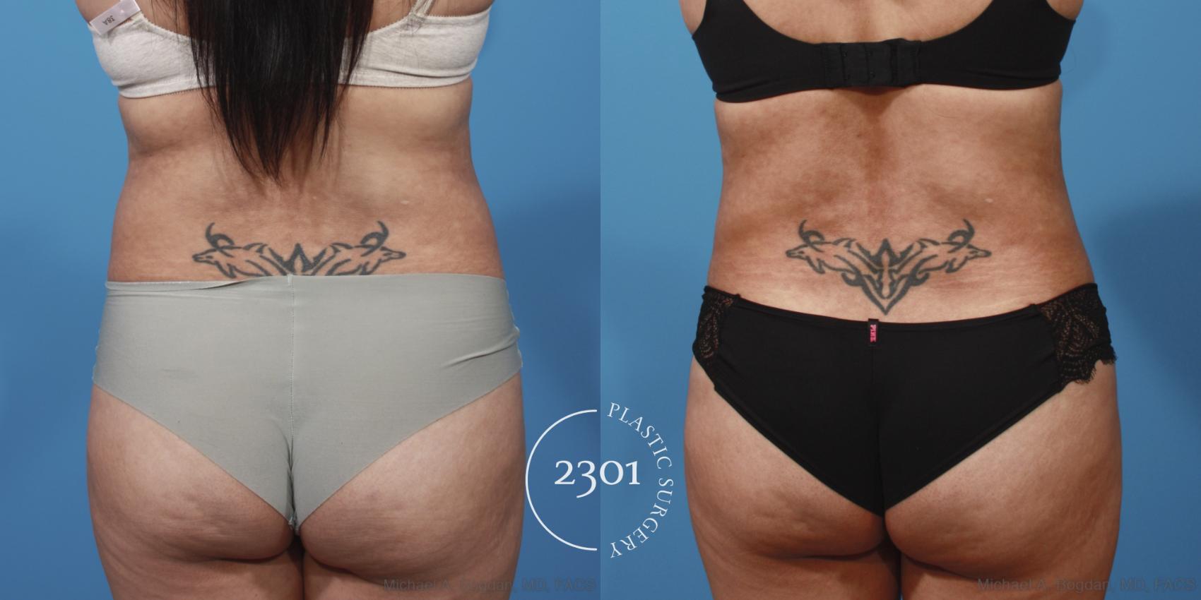 Before & After Tummy Tuck Case 653 Back View in Fort Worth, Plano, & Frisco, Texas