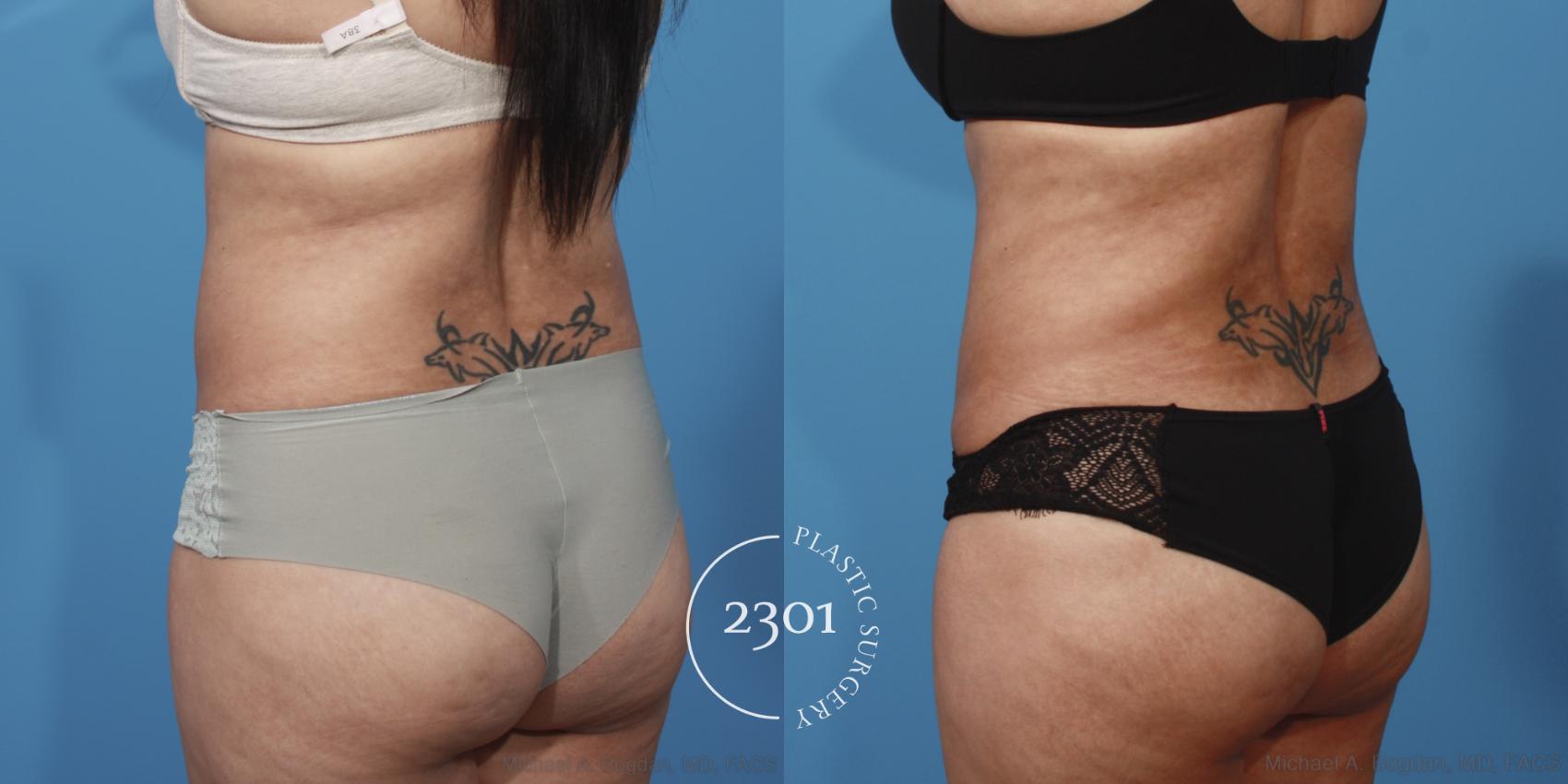 Before & After Tummy Tuck Case 653 Back Left Oblique View in Fort Worth, Plano, & Frisco, Texas