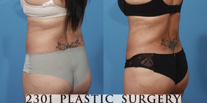 Before & After Tummy Tuck Case 653 Back Left Oblique View in Fort Worth, Plano, & Frisco, Texas