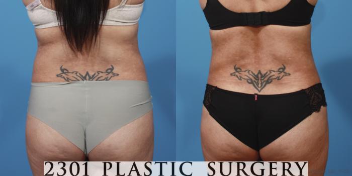 Before & After Tummy Tuck Case 653 Back View in Fort Worth, Plano, & Frisco, Texas