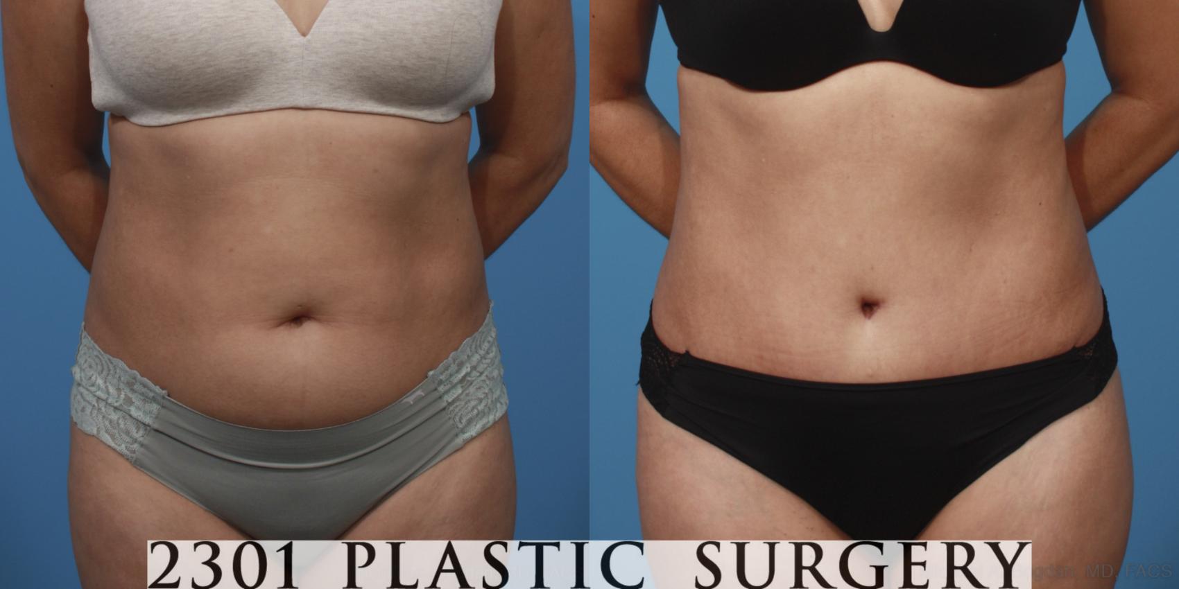 Before & After Tummy Tuck Case 653 Front View in Fort Worth, Plano, & Frisco, Texas