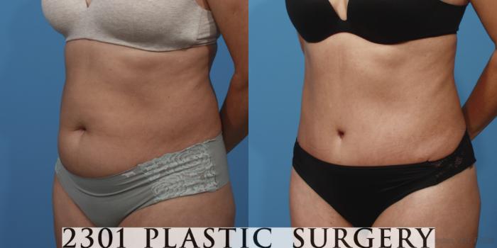 Before & After Tummy Tuck Case 653 Left Oblique View in Fort Worth, Plano, & Frisco, Texas