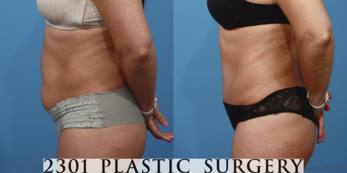 Before & After Tummy Tuck Case 653 Left Side View in Fort Worth, Plano, & Frisco, Texas