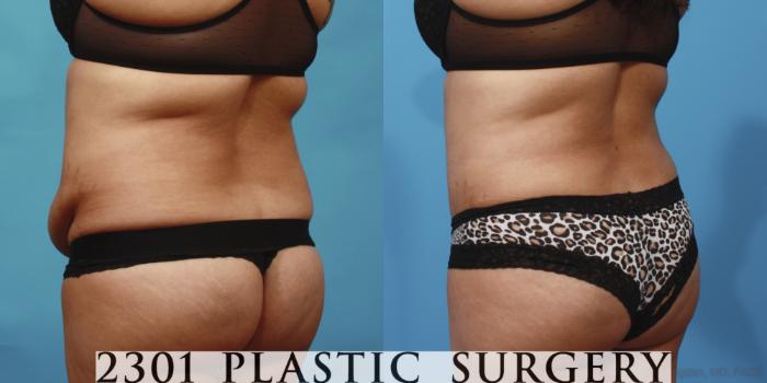 Before & After Tummy Tuck Case 654 Back Left Oblique View in Fort Worth, Plano, & Frisco, Texas