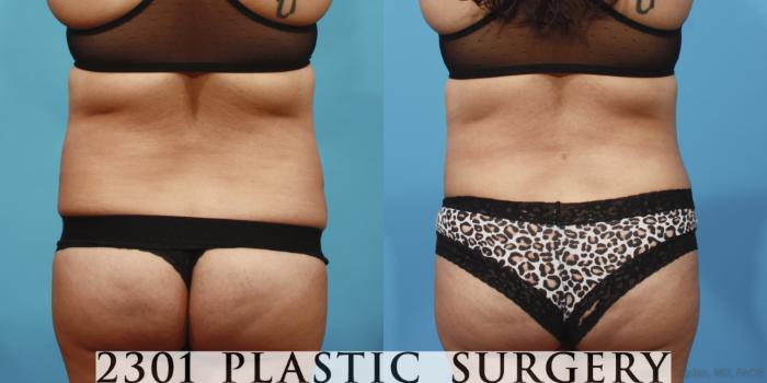 Before & After Tummy Tuck Case 654 Back View in Fort Worth, Plano, & Frisco, Texas