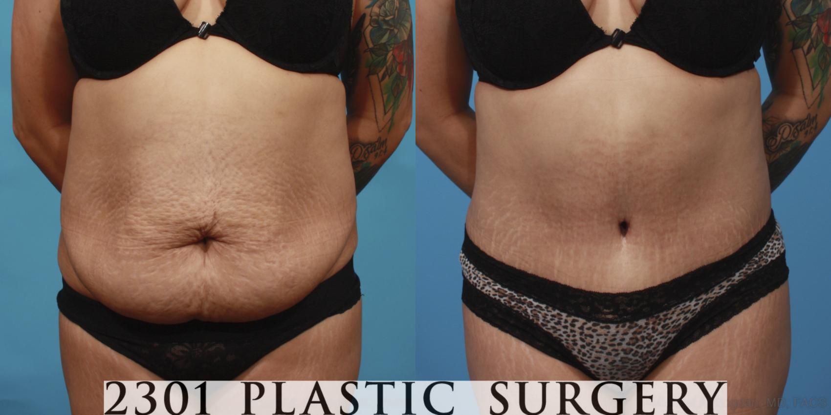 Before & After Tummy Tuck Case 654 Front View in Fort Worth & Frisco, Texas