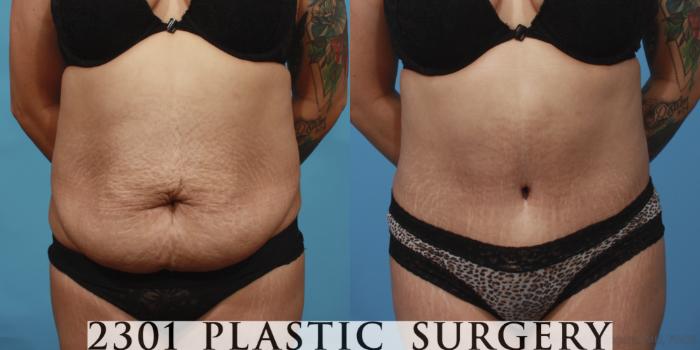 Before & After Tummy Tuck Case 654 Front View in Fort Worth, Plano, & Frisco, Texas