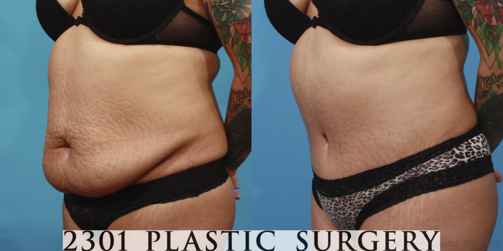 Before & After Tummy Tuck Case 654 Left Oblique View in Fort Worth & Frisco, Texas