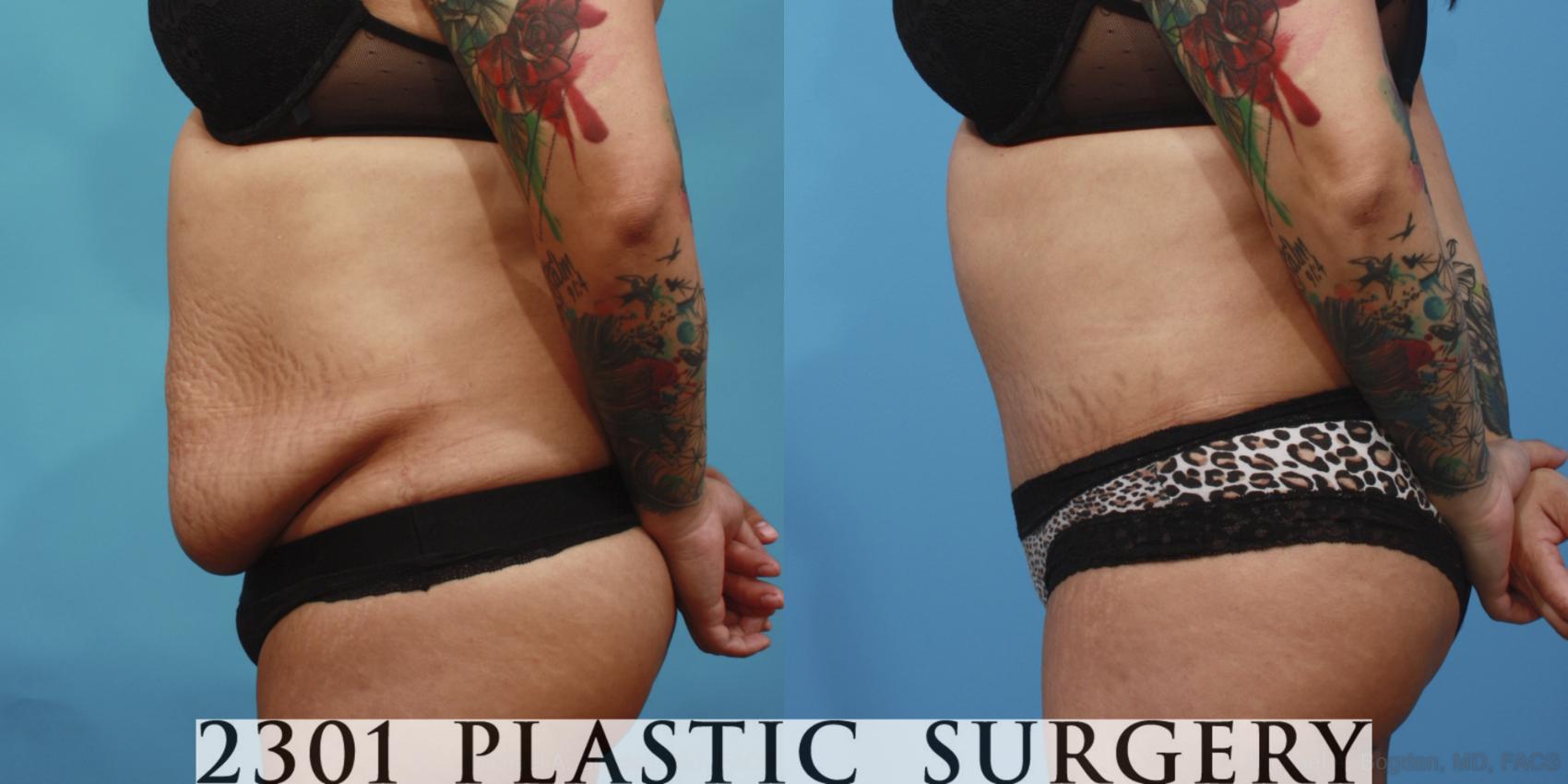 Before & After Tummy Tuck Case 654 Left Side View in Fort Worth & Frisco, Texas