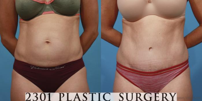 Before & After Tummy Tuck Case 655 Front View in Fort Worth, Plano, & Frisco, Texas