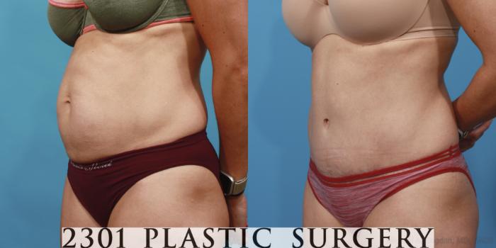 Before & After Tummy Tuck Case 655 Left Oblique View in Fort Worth, Plano, & Frisco, Texas