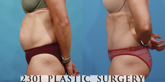 Before & After Tummy Tuck Case 655 Left Side View in Fort Worth, Plano, & Frisco, Texas