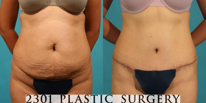 Before & After Tummy Tuck Case 69 View #1 View in Fort Worth, Plano, & Frisco, Texas
