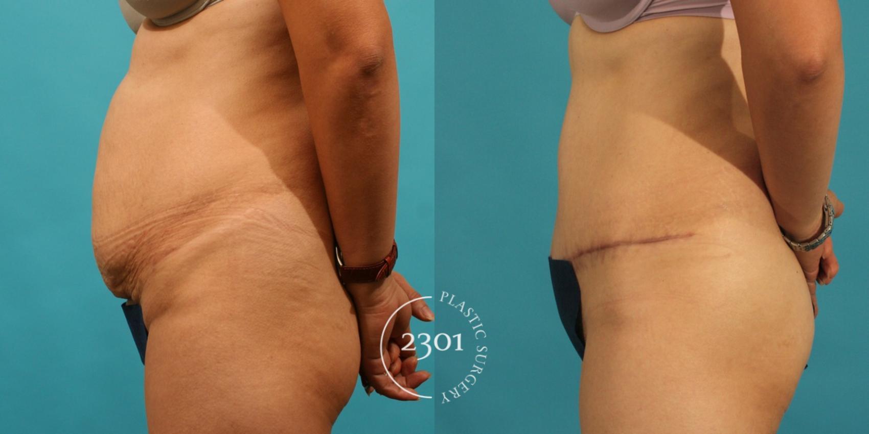 Before & After Tummy Tuck Case 69 View #2 View in Fort Worth, Plano, & Frisco, Texas