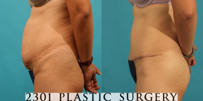 Before & After Tummy Tuck Case 69 View #2 View in Fort Worth, Plano, & Frisco, Texas