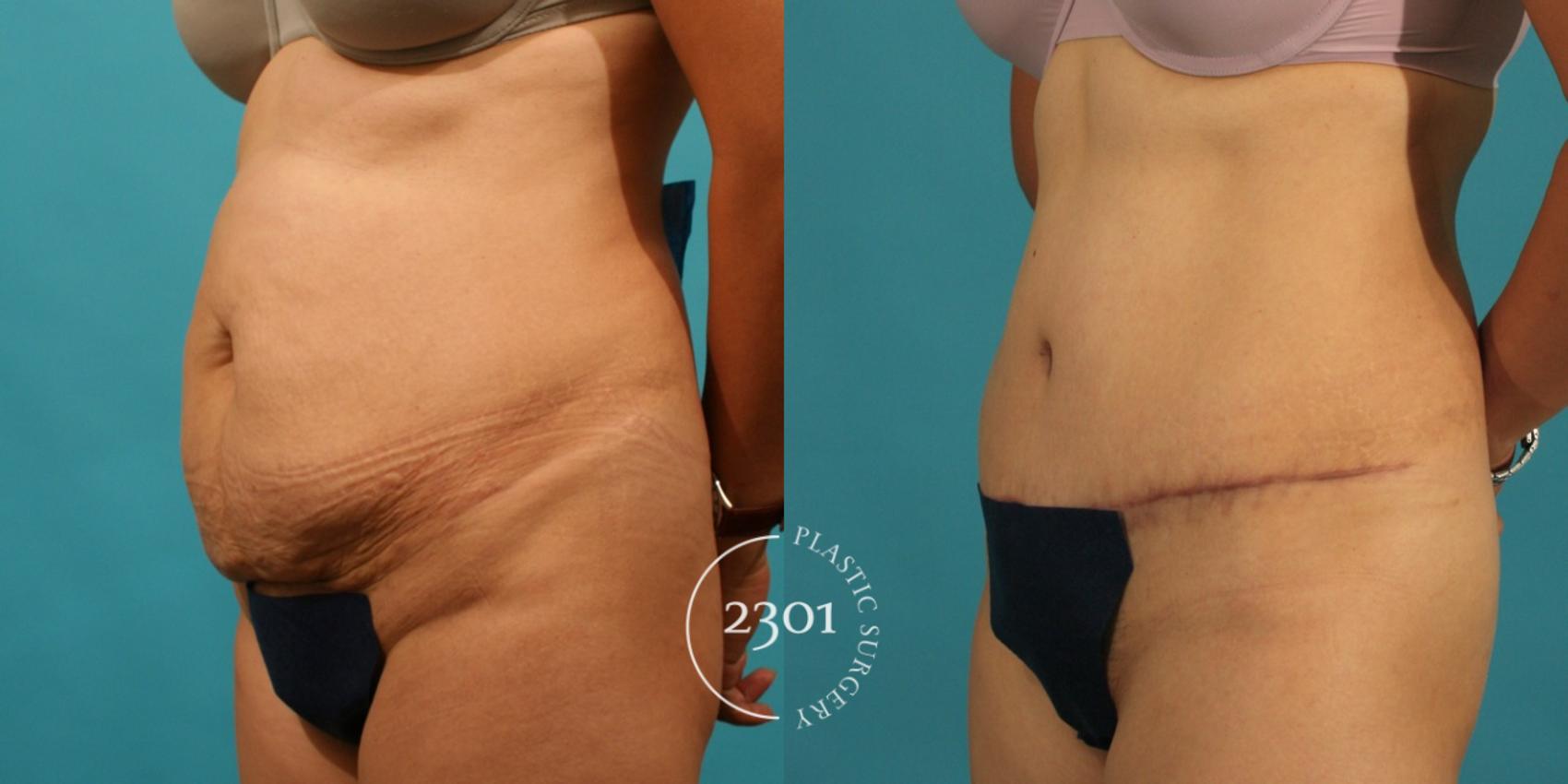 Before & After Tummy Tuck Case 69 View #3 View in Fort Worth, Plano, & Frisco, Texas