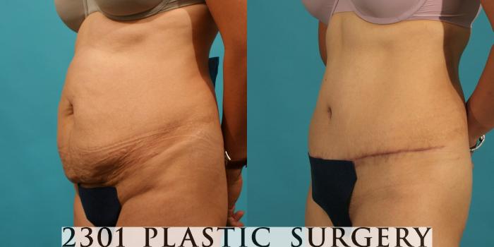 Before & After Tummy Tuck Case 69 View #3 View in Fort Worth, Plano, & Frisco, Texas