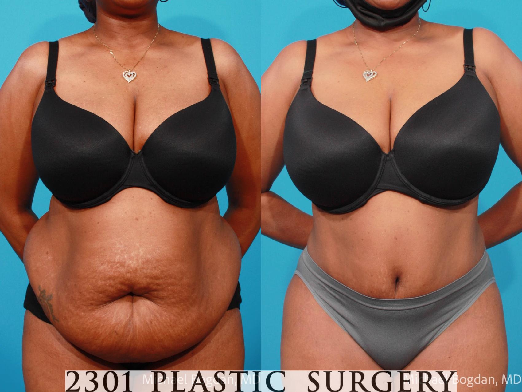 Before & After Tummy Tuck Case 695 Front View in Fort Worth, Plano, & Frisco, Texas