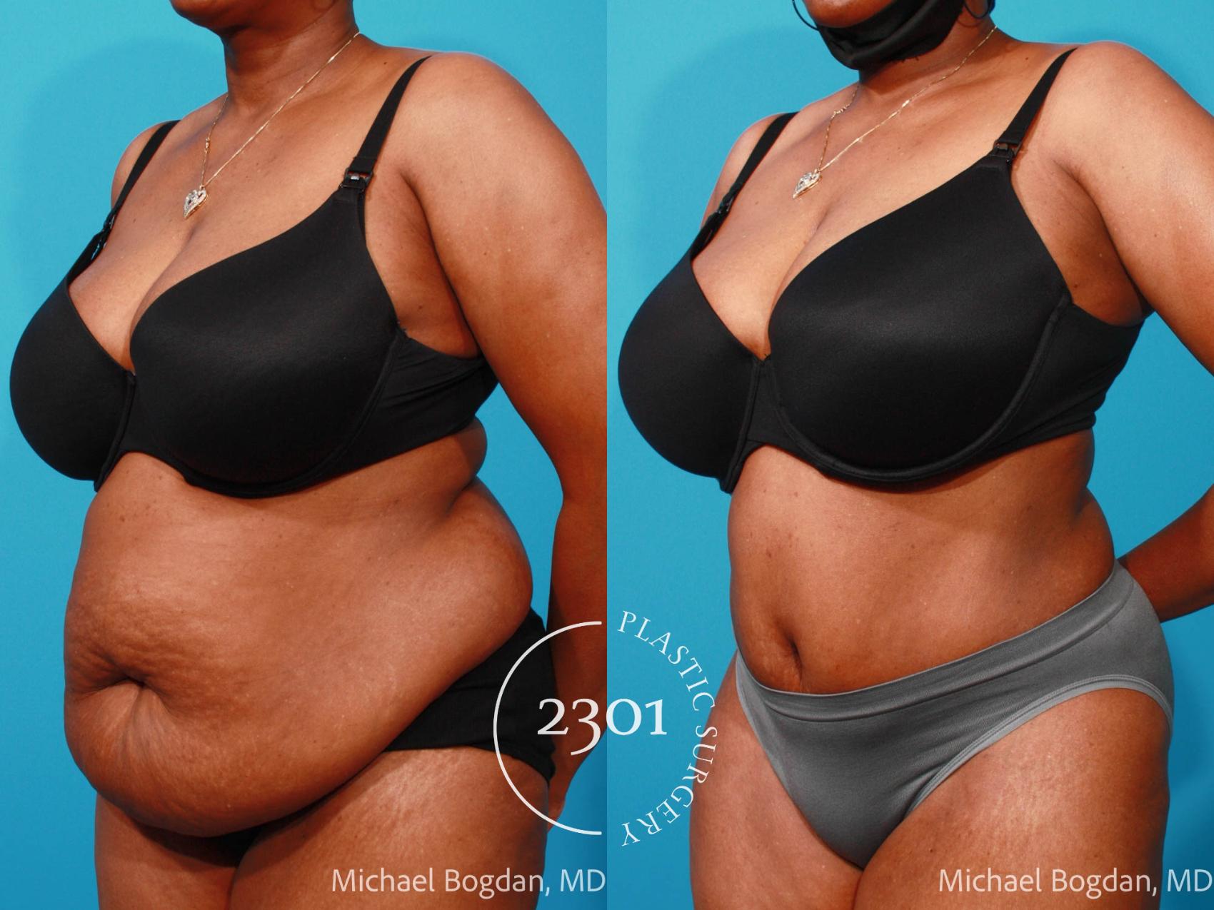 Before & After Tummy Tuck Case 695 Left Oblique View in Fort Worth, Plano, & Frisco, Texas