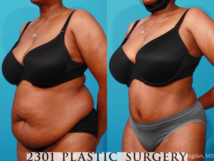 Before & After Tummy Tuck Case 695 Left Oblique View in Fort Worth, Plano, & Frisco, Texas