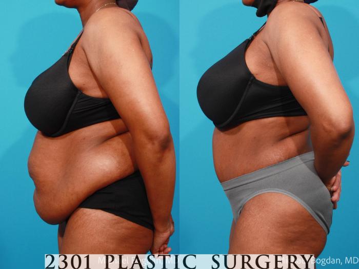 Before & After Tummy Tuck Case 695 Left Side View in Fort Worth, Plano, & Frisco, Texas