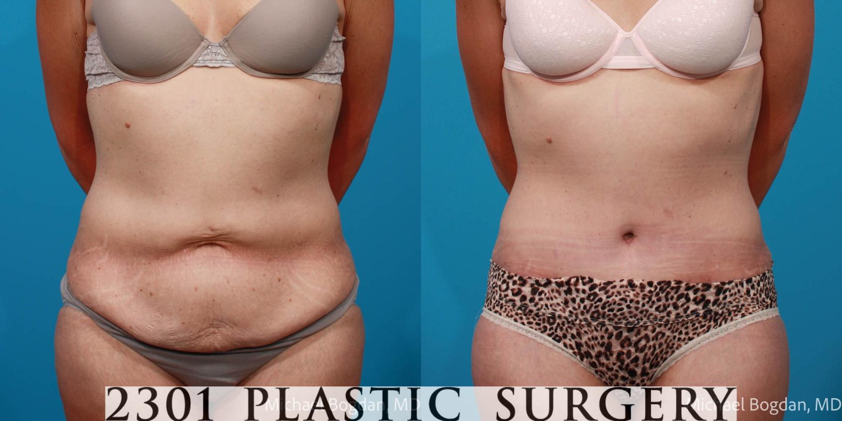 Before & After Tummy Tuck Case 697 Front View in Fort Worth, Plano, & Frisco, Texas