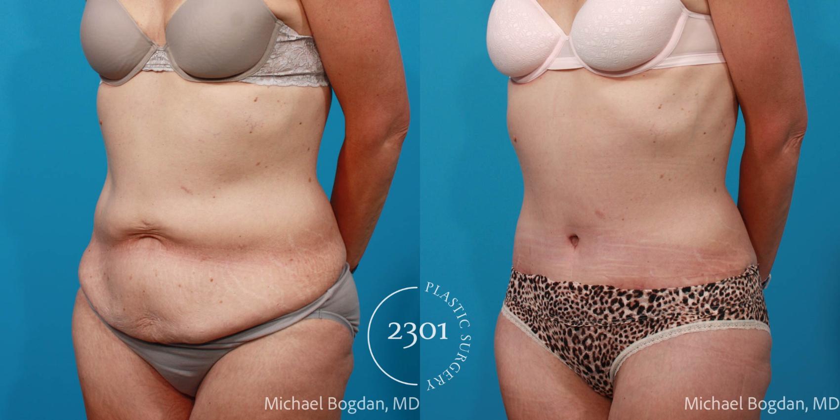Before & After Tummy Tuck Case 697 Left Oblique View in Fort Worth, Plano, & Frisco, Texas